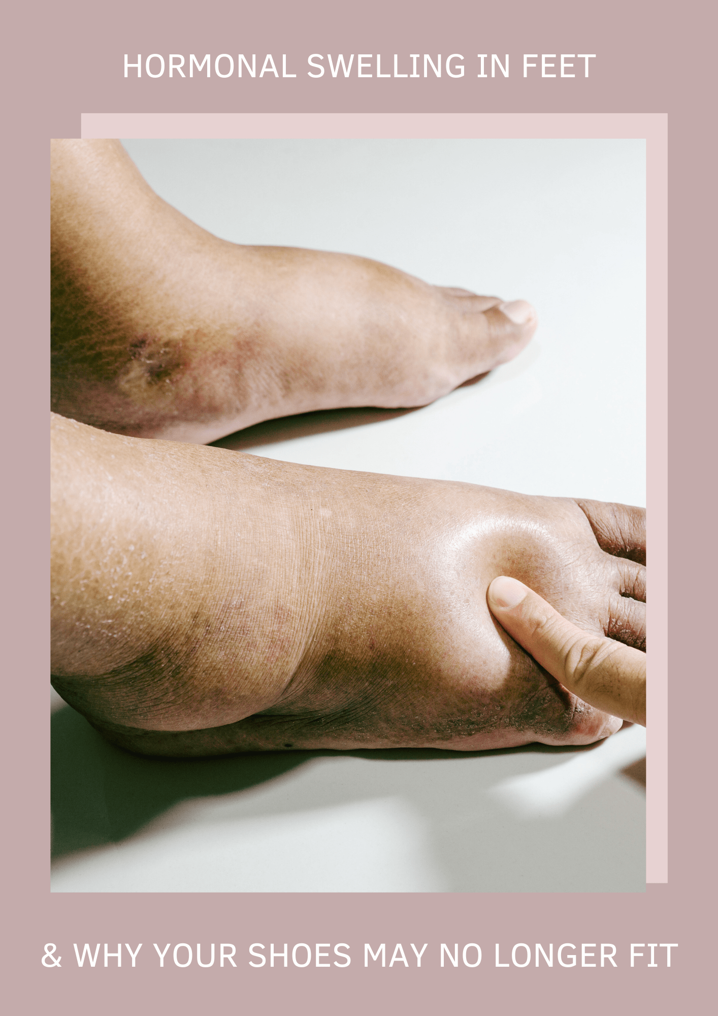 Hormonal swelling of feet during perimenopause and menopause
